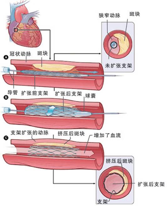 怎样治疗冠心病?(图2) 怎样治疗冠心病?(图2)