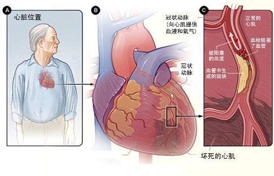 怎样治疗冠心病?(图3) 怎样治疗冠心病?(图3)